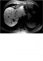 Graphical Abstract of Mangafodipir trisodium: review of its use as an injectable contrast medium for magnetic resonance imaging
